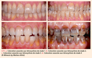 Dyschromies dentaires