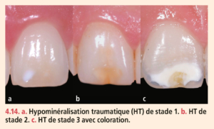 Dyschromies dentaires
