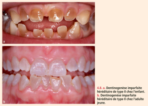 Dyschromies dentaires