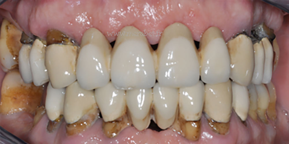 dents-1