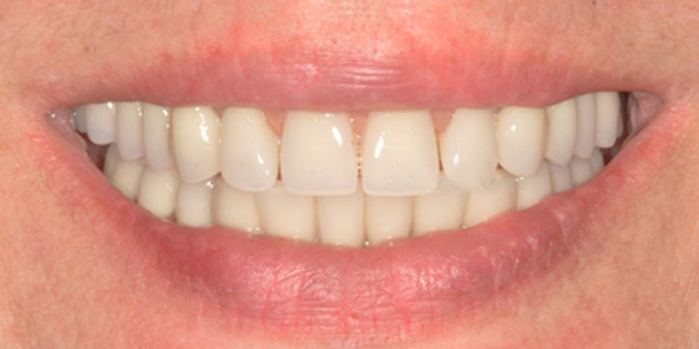 dents-10