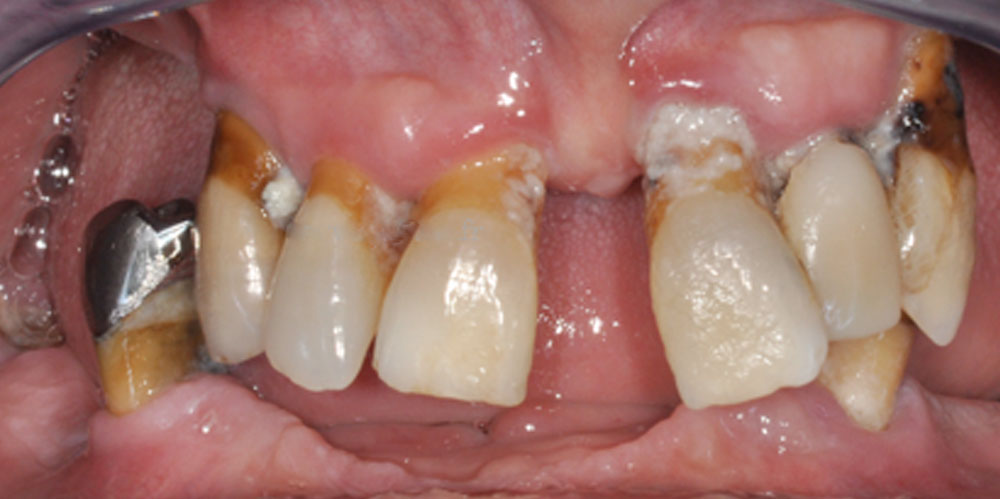 dents-13
