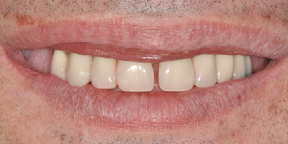 dents-14