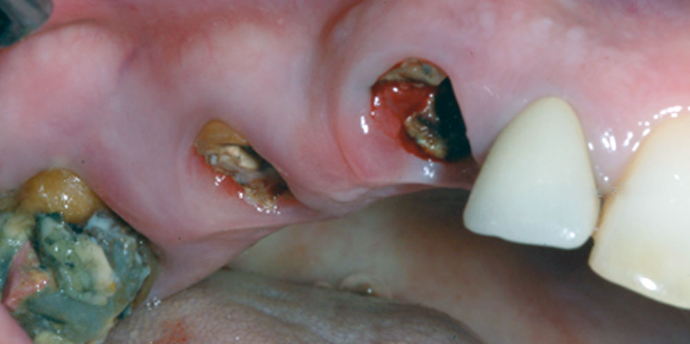 dents-17