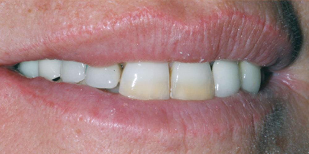 dents-18
