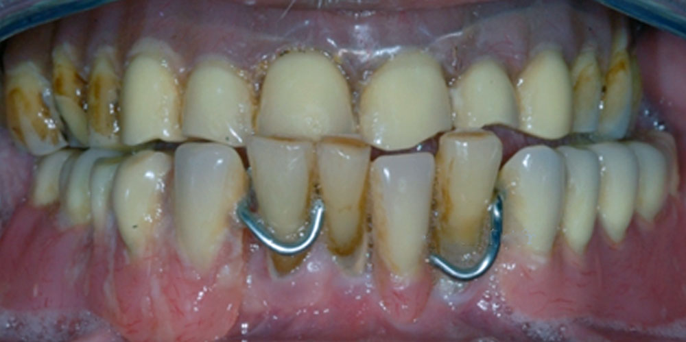 dents-19