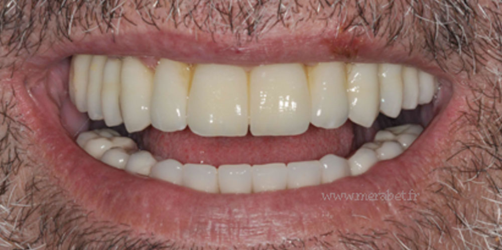 dents-2