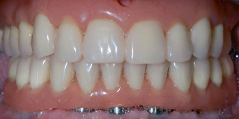 dents-20