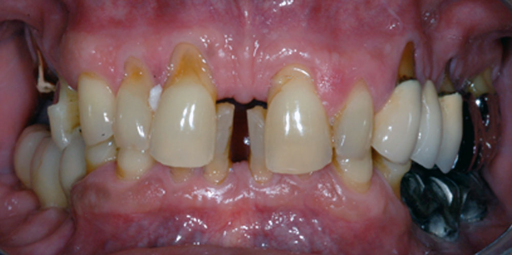 dents-3