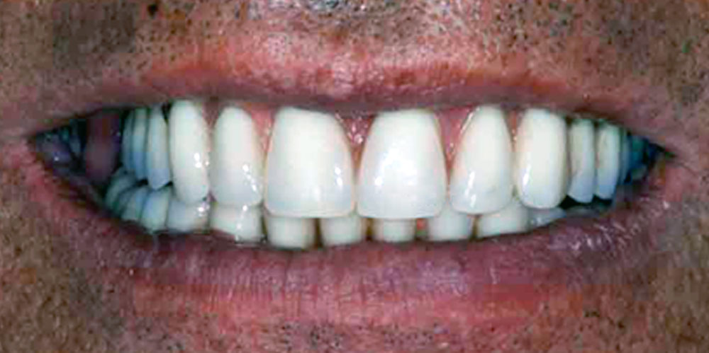 dents-4