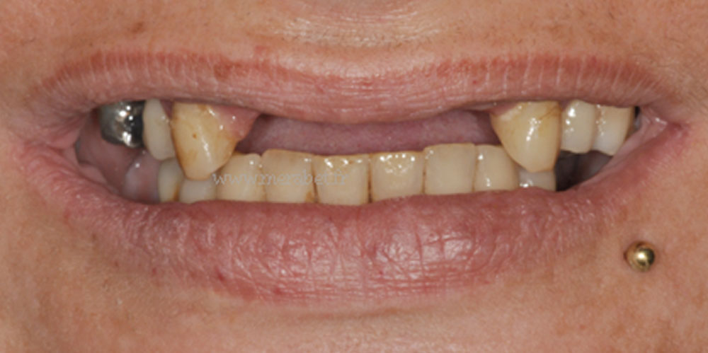 dents-5
