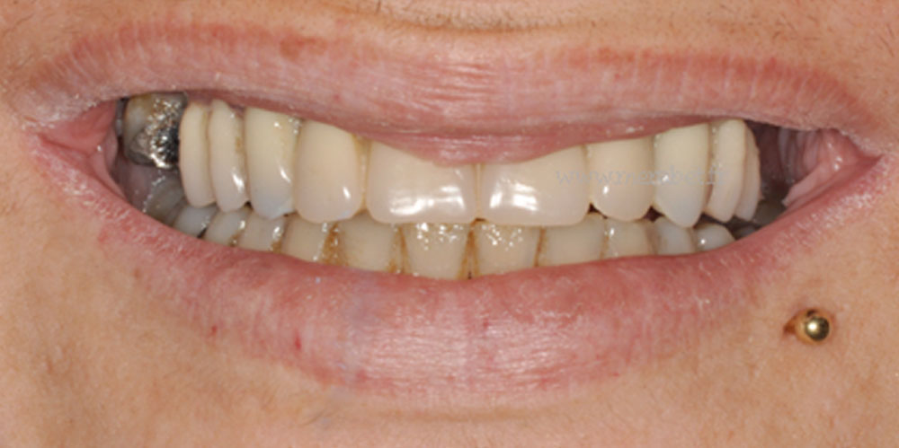 dents-6