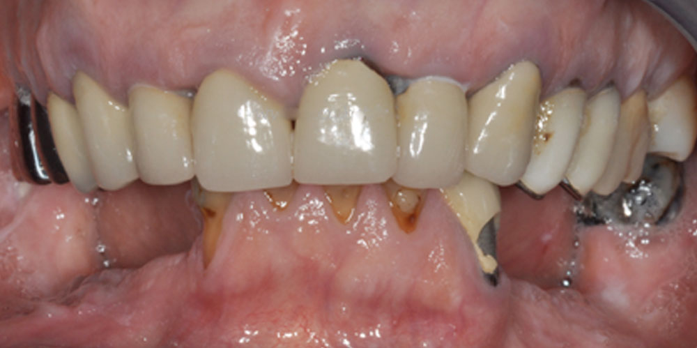 dents-7