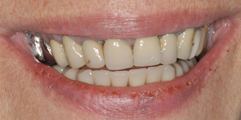 dents-8