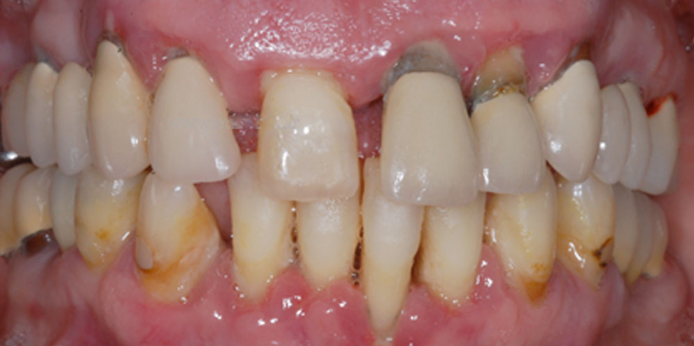 dents-9