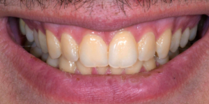 Eclaircissement externe