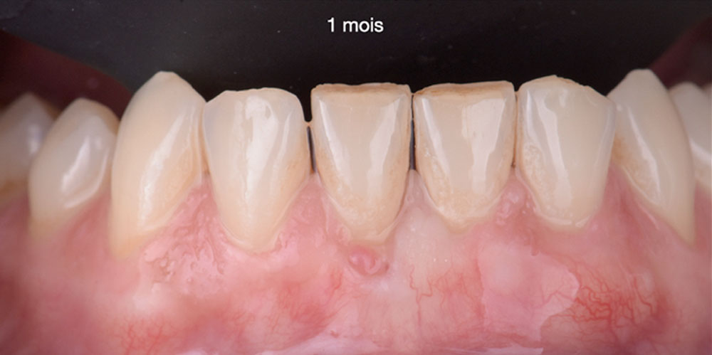 greffe-de-gencive-2