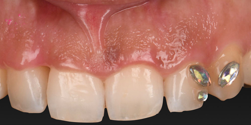 greffe-de-gencive-3