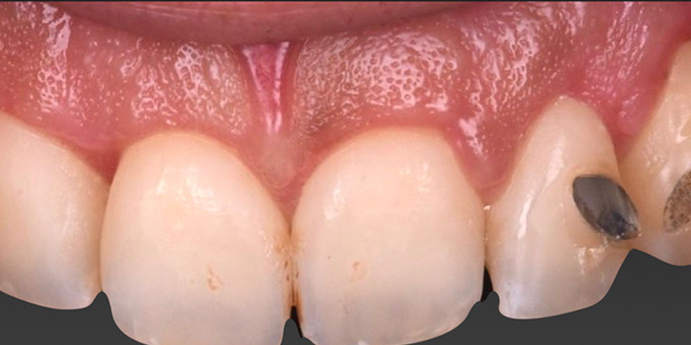 greffe-de-gencive-4