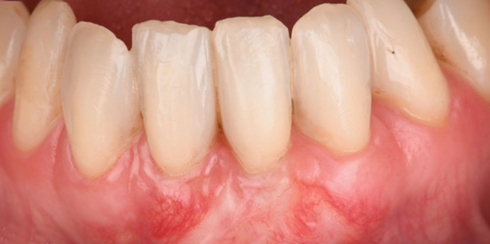 greffe-de-gencive-8