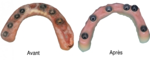 implants dentaires