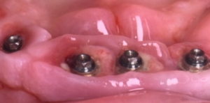 implants dentaires