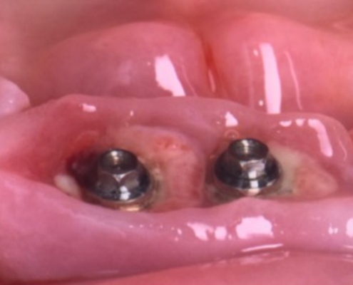implants dentaires