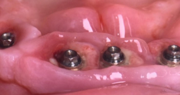 implants dentaires