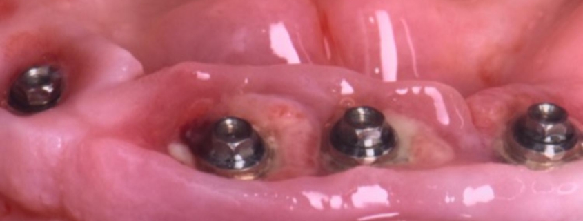 implants dentaires